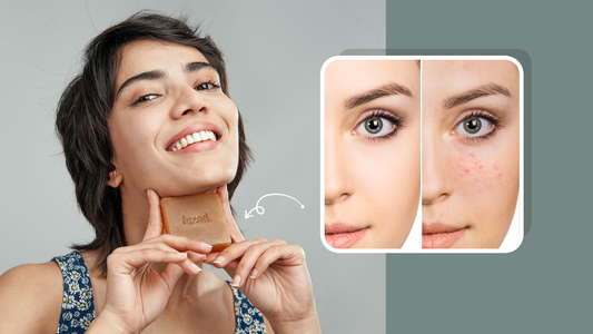 The Complete Guide For The Best Fuzed Acne Soap Bar