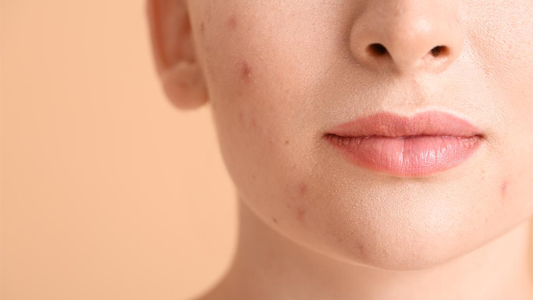 How To Treat Acne And Dry Skin - 9 Ways For A Beautiful Acne