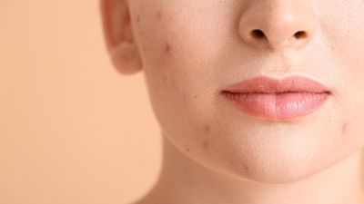 How To Treat Acne And Dry Skin - 9 Ways For A Beautiful Skin