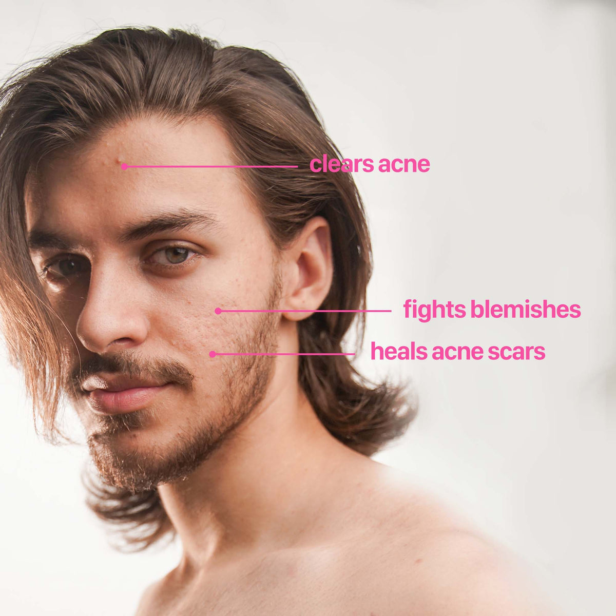 The Acne Serum with 2% Salicylic Acid and 1% Hyaluronic Acid - Fuzed Skincare